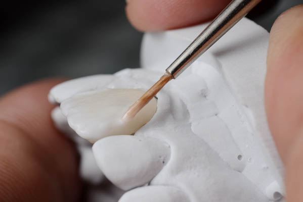 How Is Dental Bonding Used In Cosmetic Dentistry?