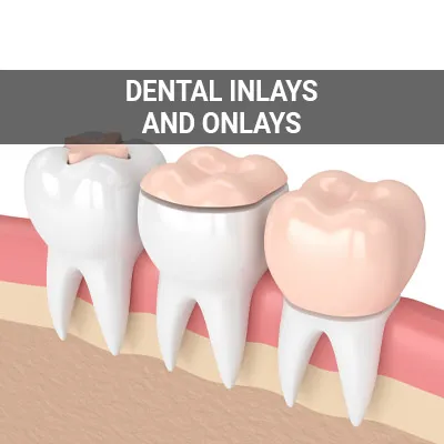 Visit our Dental Inlays and Onlays page